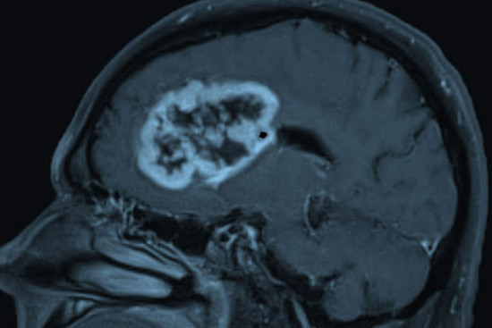 Potential drug target identified for deadly brain cancer ...