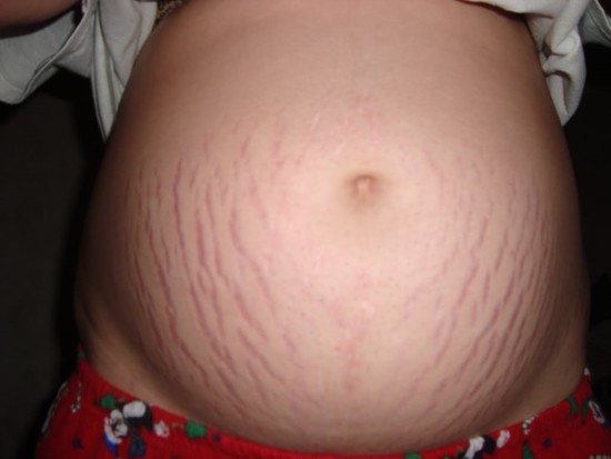 Blog - Learn How To Get Rid Of Stretch Marks