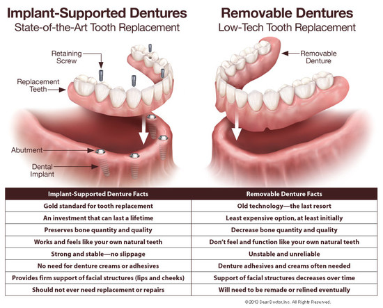 Fixed vs. Removable Dentures - Dentist Belmont, CA ...