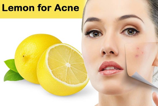 Lemon Juice for Acne Scars: Is it Good for You