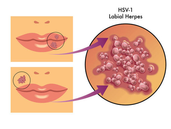 Herpes simplex 1 antibodies - Things You Didn't Know