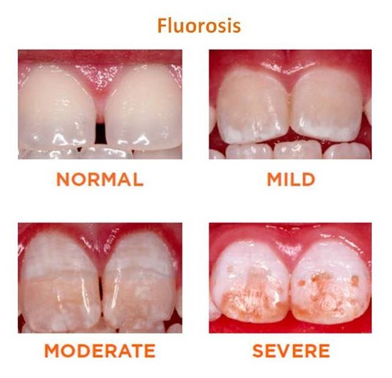 The Fluoride affect on tooth enamel. - Cosmetic Dentist ...