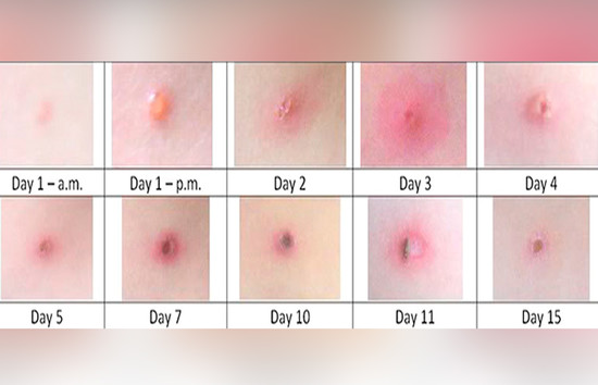 What Does Chickenpox Look Like And Its Home Remedies