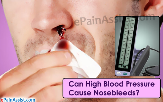 Can High Blood Pressure Cause Nosebleeds?