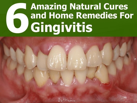 6 Natural Cures and Home Remedies For Gingivitis