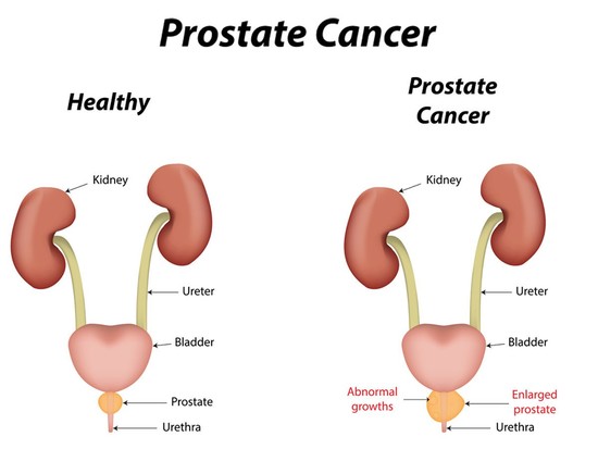 Overview of Prostate Cancer