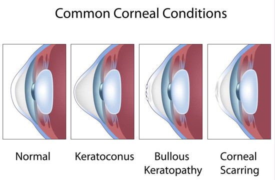 Facts about C3R keratoconus treatment