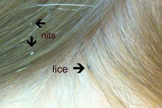 Nits and head lice: a parent's guide - Netmums