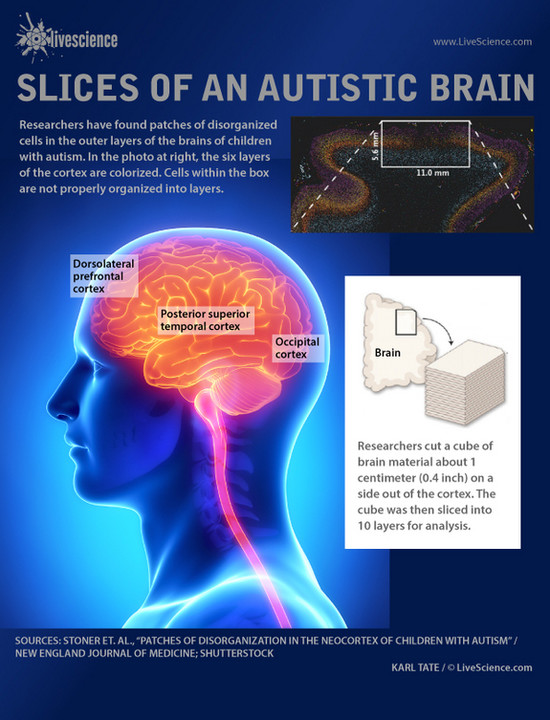New Research Finds Cell Damage in Autistic Brain (Infographic)
