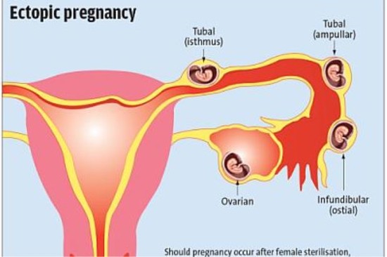 Sterilising a woman - Health | The Star Online