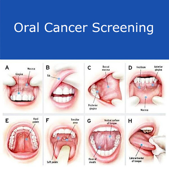 Early Symptoms and Possible Prevention of Oral Cancer ...
