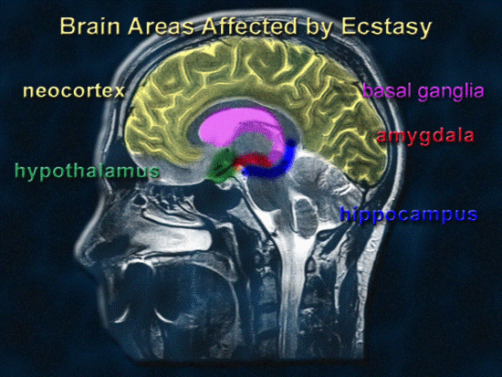 Long-term Ecstasy use as Risk Factor for Alzheimer's ...