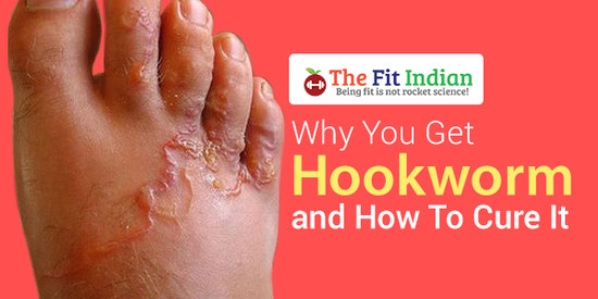Top 10 Herbal Recipes and Remedies to Cure Hookworm ...