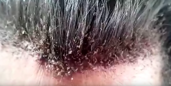 How to get rid of Head Lice, control Pediculus Humanus ...