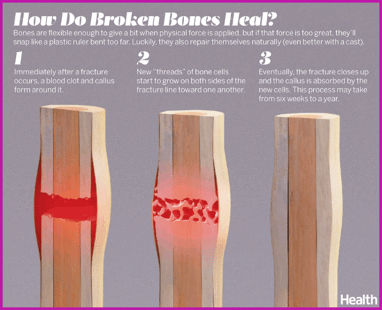 How Do Broken Bones Heal?