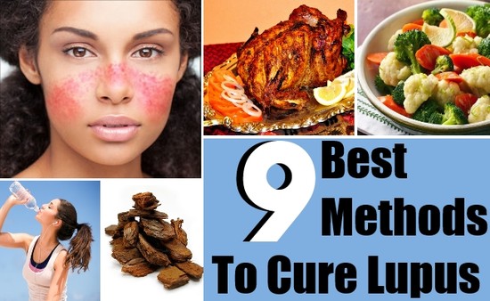 9 Best Methods To Cure Lupus | DIY Health Remedy