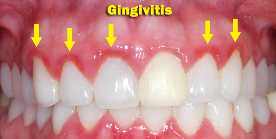 Gingivitis | Stainless Smile Africa