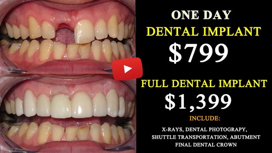 All on 6 Dental Implant Cost in Tijuana, Mexico Save Up 75 ...