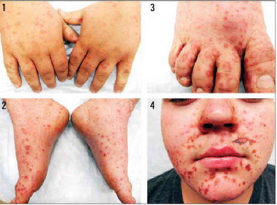 Hand, foot and mouth disease affects kids more – Punch ...
