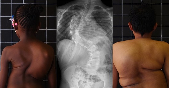 Related Keywords & Suggestions for severe scoliosis