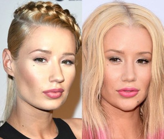 Iggy Azalea plastic surgery before and after