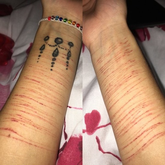 What is it like to live with self harm scars? - Quora