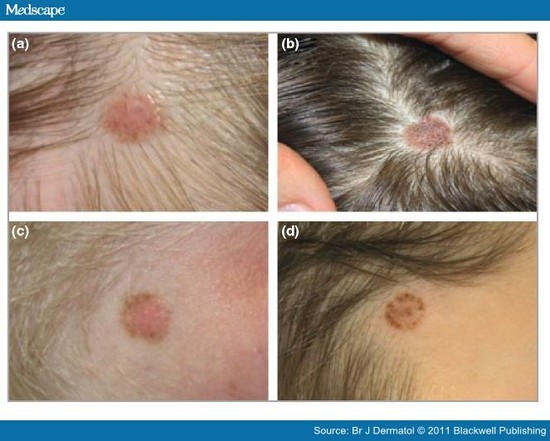 Clinical and Dermoscopic Features of Scalp Naevi in Children