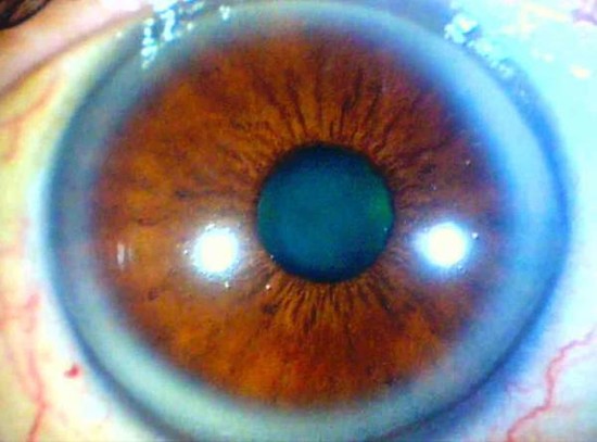 Blue ring around brown eye - Doctor answers