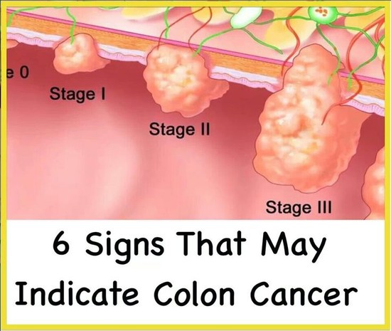39 best COLON CANCER images on Pinterest | Colon cancer ...