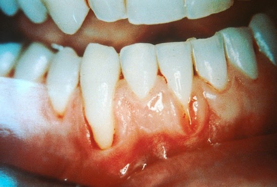 Why Do People Want Whiter Teeth?: Over Bleaching Harms ...