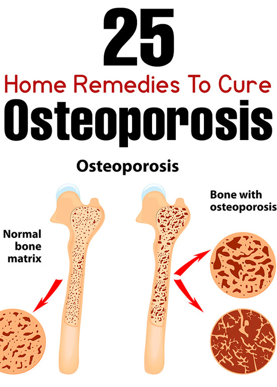 25 Effective Home Remedies To Cure Osteoporosis
