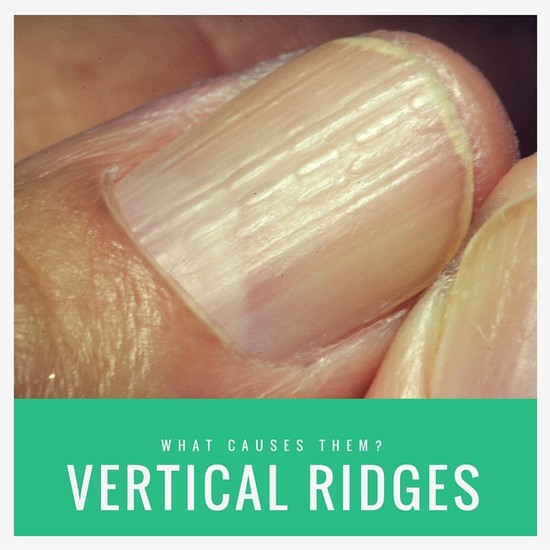 Vertical Ridges On Fingernails: What Causes Them?