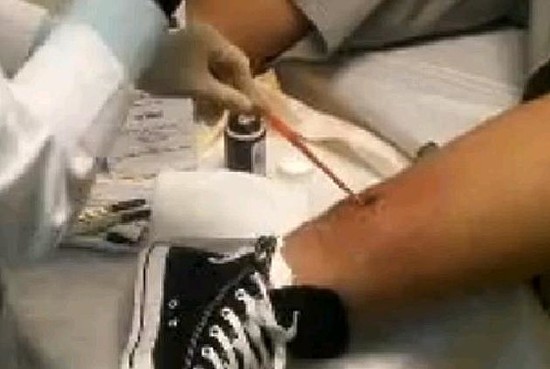 Pulling A Tapeworm Out of Your Leg [Video]
