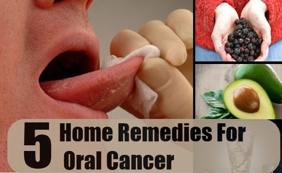 5 Effective Home Remedies For Oral Cancer - Natural ...