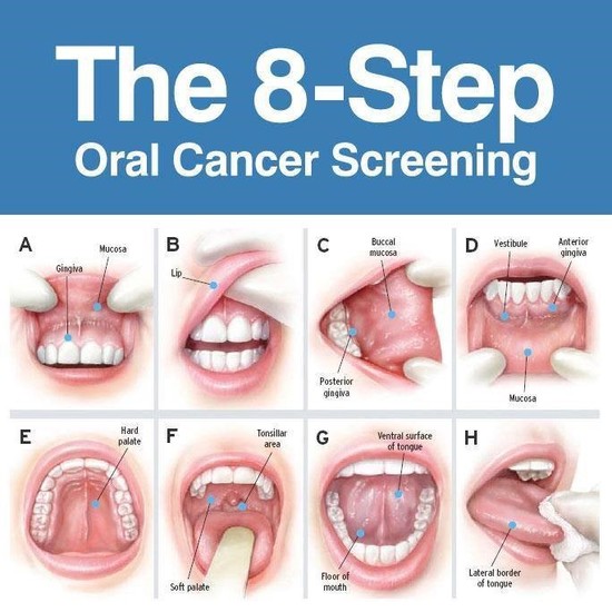 Mouth Cancer - Dee Shapland Dental Surgery