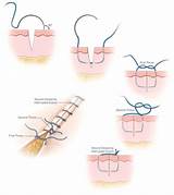 Line of Interrupted Sutures