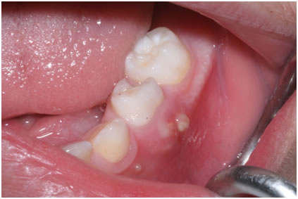 Dental fistula