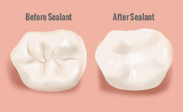Fissure Sealants â Not just for kids! Why you may benefitâ ...