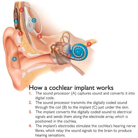 I am a deaf person with a cochlear implant. AMA : IAmA