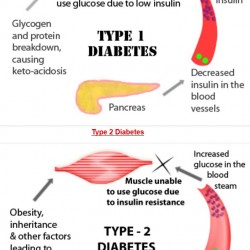 Diabetes: Type 1 Diabetes v/s Type 2 Diabetes | Visual.ly