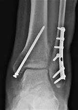 Ankle: Repair of Ankle Fracture