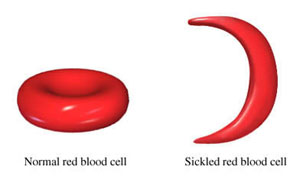 Cancer, A Lab Tech 's Perspective: Blood Disorder: Sickle ...