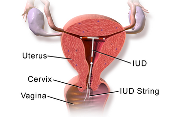 Chances of Getting Pregnant with an IUD (Mirena ...