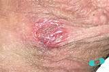 Online Dermatology - Genital Herpes