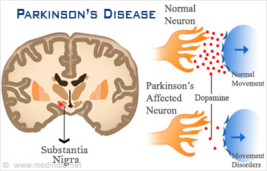HOW IS PARKINSON’S DISEASE TREATED « Kathy Kiefer