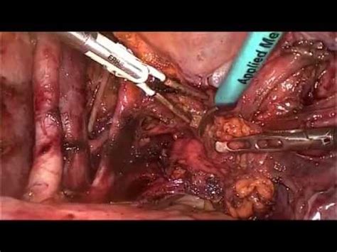 laparoscopic radical hysterectomy for cervical cancer ...