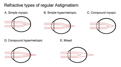 Pics For > Correction Of Astigmatism