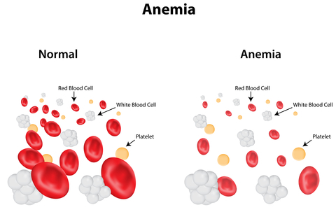 Do You Have Anemia? Surprising Signs and Symptoms You ...