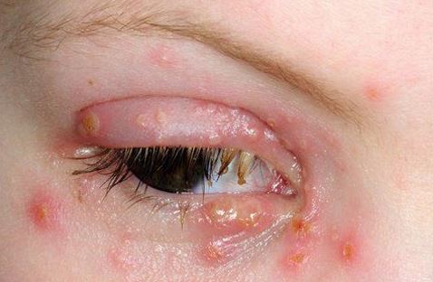 Toddler Eye Discharge, Causes, Fever, Green, Yellow, Cold ...