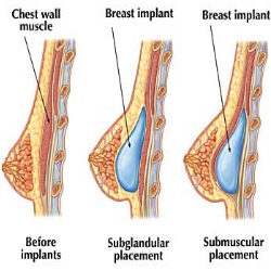 Advantages And Disadvantages Of Breast Implants With Fat ...